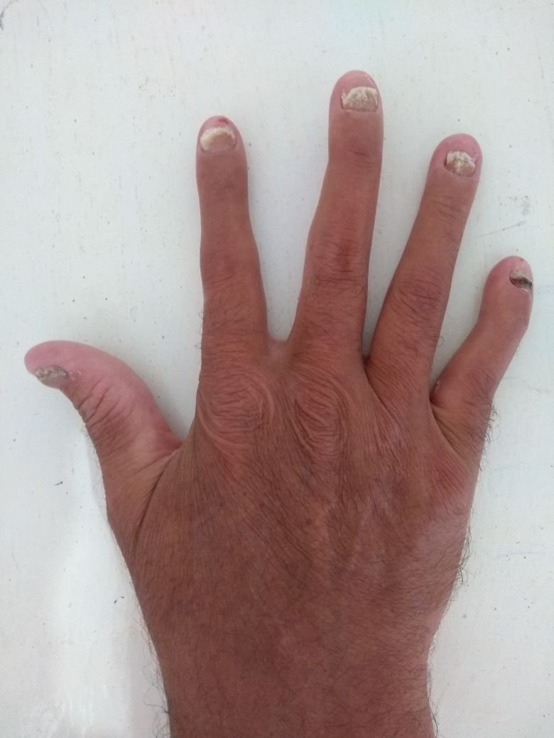 Cicatriz na mão de ferida curada