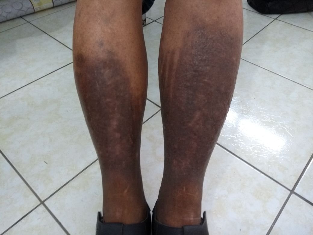 Panturrilha com cicatriz de ferida curada