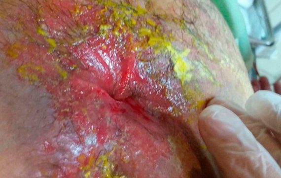 Barriga com uma ferida