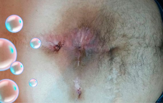 Barriga com cicatriz de ferida curada