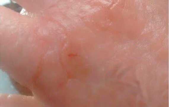 Mão com cicatriz de ferida curada