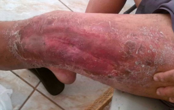 Cicatriz na perna de ferida curada