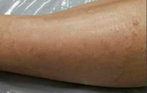 Cicatriz na perna de ferida curada