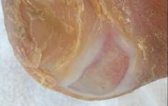 Cicatriz no pé de ferida curada
